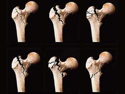 骨密度仪厂家告诉您常见骨质硫松性骨折的临床表现