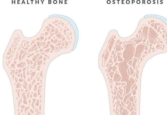 骨密度仪阐述光靠吃钙片就可以预防骨质疏松吗？